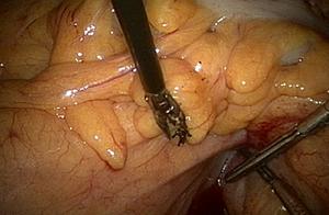 New approaches to Minimally Invasive Surgery for Colon and Rectal tumors.