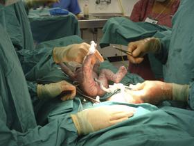 C Section Birth