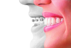 Not seeing is believing -- Invisalign vs. traditional metal braces. An ideal fit for busy teen lifestyles.  For more information, please visit: www.InvisalignTeen.com.