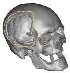 CT scanned data converted to CADCAM  data showing damaged area due to trama.