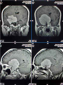 'She was told,' according to Dr. Gabriel Phillips, 'there was no medical treatment for her condition and she needed surgical resection and the political environment was too unstable to get that done where she was.'   If the patient did not receive the urgent care she required, she was facing the outcome of complete vision loss.