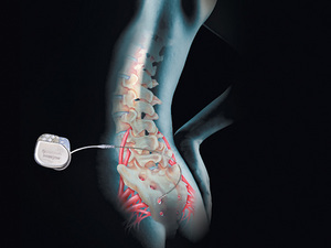 InterStim(R) is unique because of the testing process. It allows the physician and patient to gauge its effectiveness prior to undergoing a slightly more invasive implantation of the permanent device.