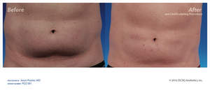 CoolSculpting Before and After