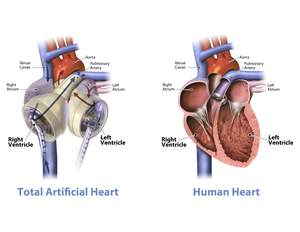 The SynCardia temporary Total Artificial Heart is the world's first and only FDA, Health Canada and CE Approved Total Artificial Heart.