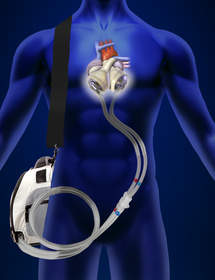 The Freedom(R) portable driver for powering SynCardia's Total Artificial Heart is CE approved for use in Europe and undergoing an FDA-approved Investigational Device Exemption (IDE) clinical study in the U.S.
CAUTION - The Freedom driver is an investigational device, limited by United States law to investigational use.
