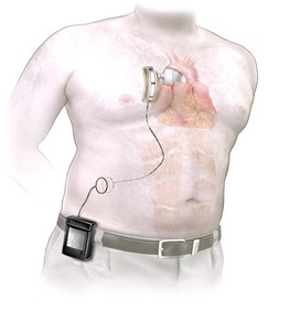 Sunshine Heart's fully-implantable C-Pulse Heart Assist System prototype. Recently tested in an animal model at Texas Heart Institute, Houston, TX. 
