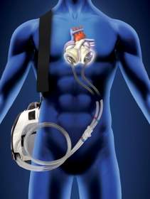 The Freedom portable driver is CE approved to power SynCardia's Total Artificial Heart in Europe and undergoing an FDA-approved Investigational Device Exemption (IDE) clinical study in the U.S. CAUTION - The Freedom portable driver is an investigational device, limited by United States law to investigational use.