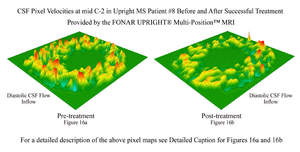 Fig. 16a is a map of the pixel velocities at mid C-2 of CSF flow in the symptomatic MS patient. Fig 16b is a pixel velocity map of CSF flow after the patient's symptoms subsided following AO treatment.  (See detailed caption in press release text).