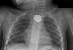 X-Ray of Button Battery Lodged in Child's Throat. Courtesy: Nationwide Children's Hospital.