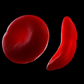 Sickle cell disease: Normal red blood cell (left) and sickled red blood cell (right)