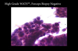 High grade dysplasia identified by WATS3D