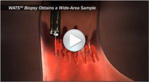 WATS3D Biopsy Overview Animation