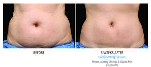 CoolSculpting Before and After Photos