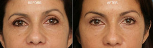 Rejuvenation Around the Eye with Orbital Fat Injections by Dr. Patrick K. Sullivan