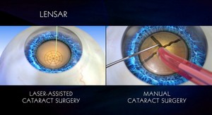 See the difference between Laser-assisted cataract surgery (LENSAR®) vs. manual cataract surgery.