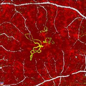 This image shows abnormal blood vessels, depicted in yellow, in the outer retina, using the innovative AngioVue system.