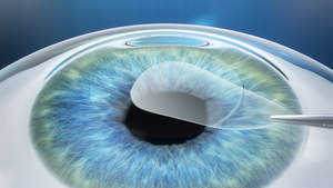 ZEISS VisuMax SMILE vision correction procedure, the latest advancement in laser eye surgery