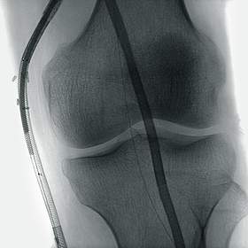 Stent-Implantierung am Knie, aufgenommen mit Ziehm Vision FD